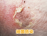 犬の細菌性皮膚炎の皮膚症状の写真